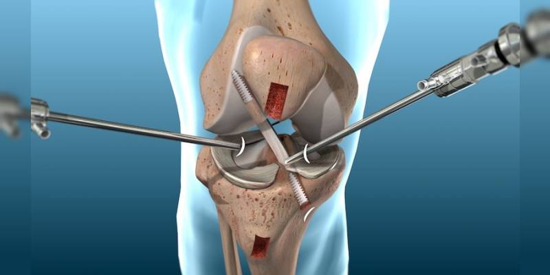 Knee arthroscopy and ACL