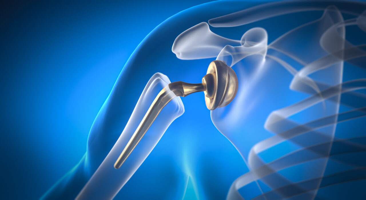 Shoulder replacement in Surat
