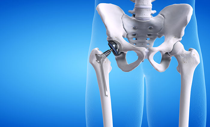 Total hip replacement in Surat