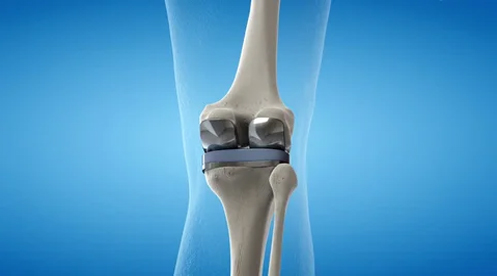 Total knee replacement in Surat